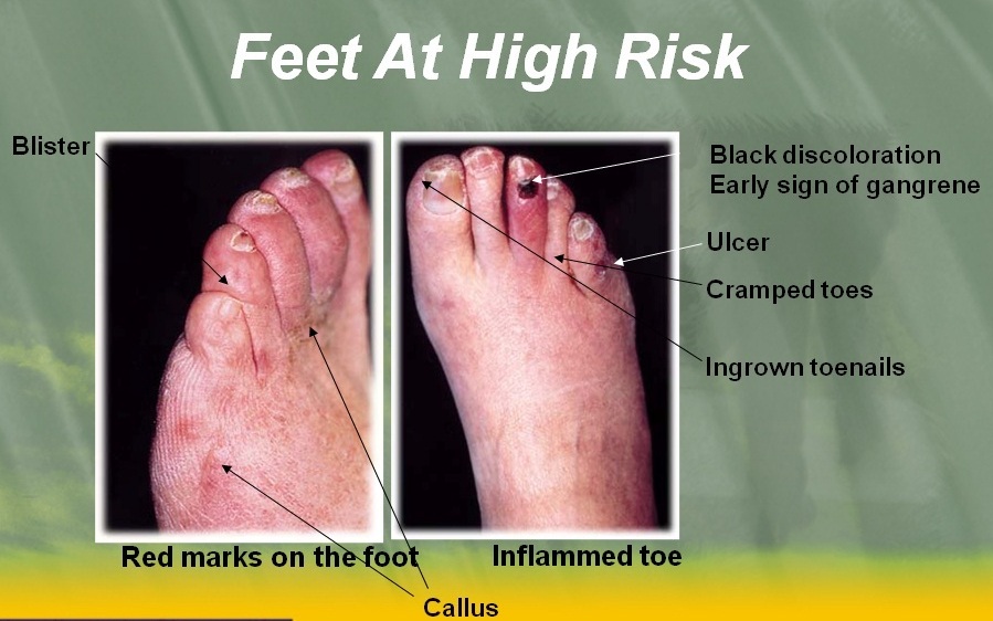 Feet First Diabetic Foot Problems