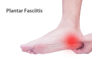 Feet First | Plantar Fasciitis