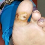 4 Days after Debridement