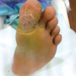 Callosity After Treatment