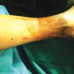 Stem-Cell-Therapy-10