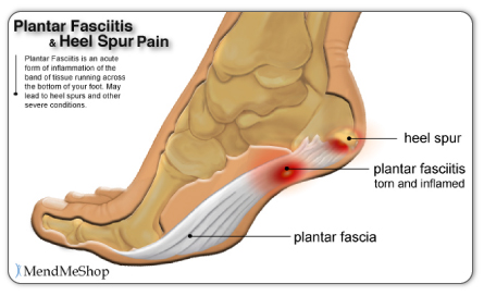 heel-spur-or-calcaneal-spur